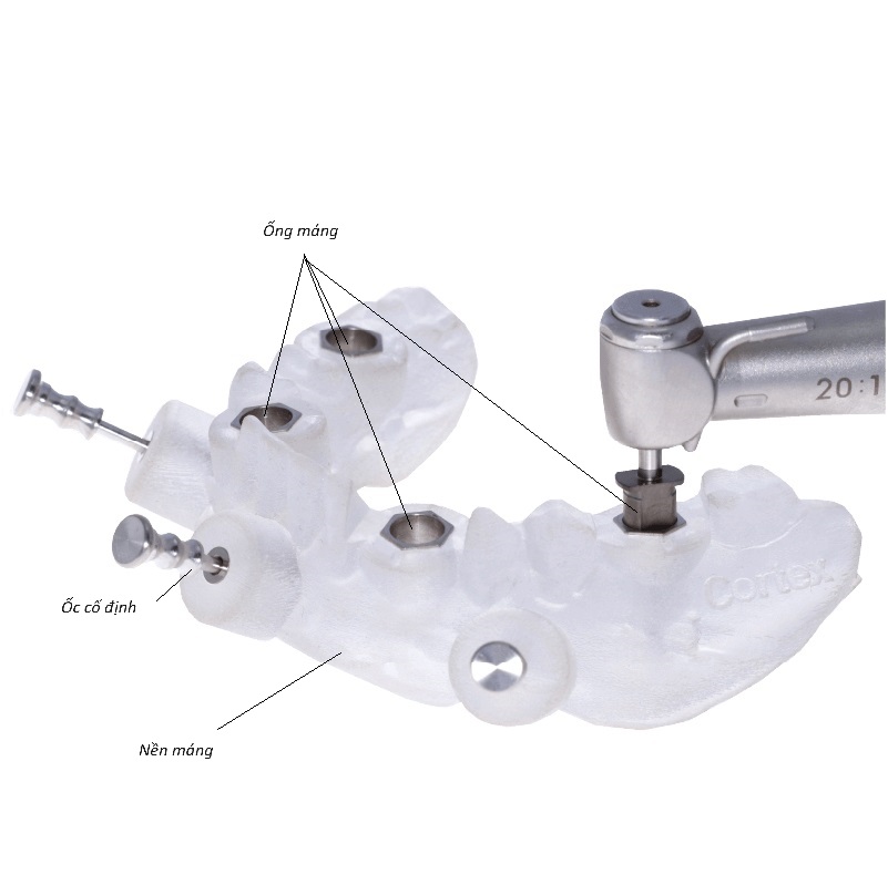máng hướng dẫn phẫu thuật trong trồng răng implant