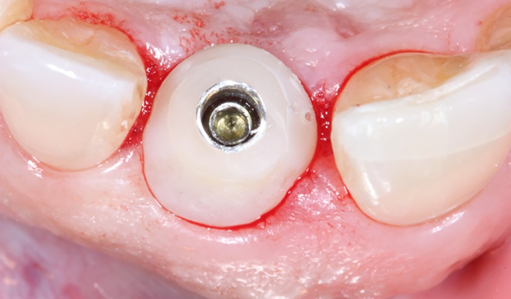 trồng răng implant cá nhân hóa