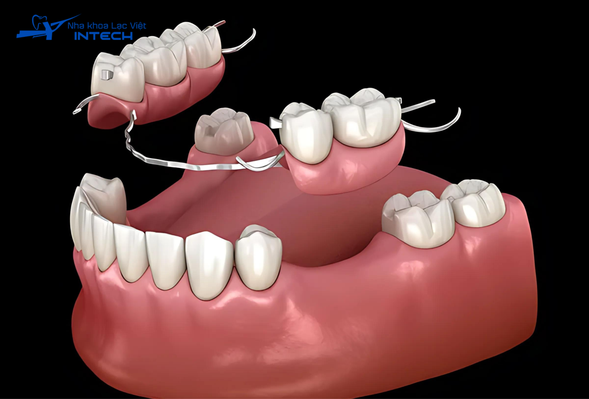 Hàm giả tháo lắp, bắc cầu răng sứ có thể là giải pháp thay thế tạm thời tuy nhiên tồn tại nhiều nhược điểm, ảnh hưởng đến sinh hoạt và ăn nhai