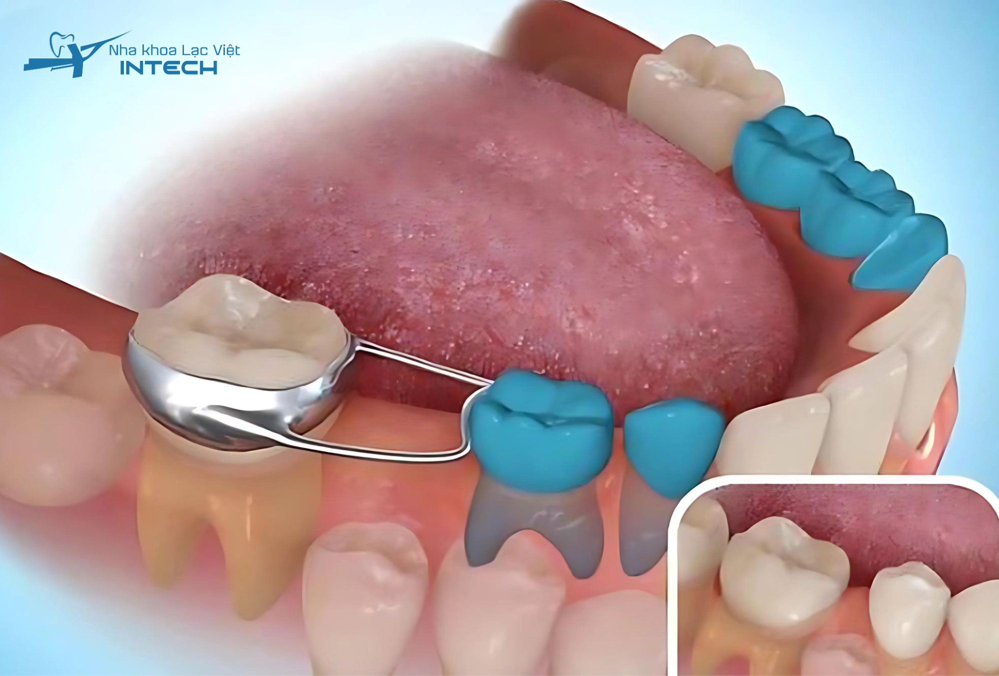 Mất răng 6 có niềng đc không