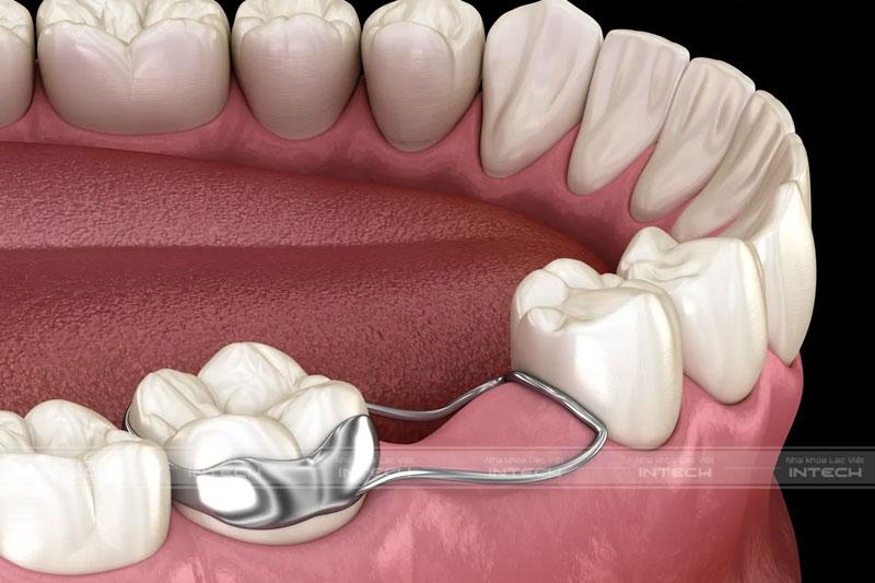 Hàm giữ khoảng giúp răng bên cạnh vị trí mất răng không bị xô lệch