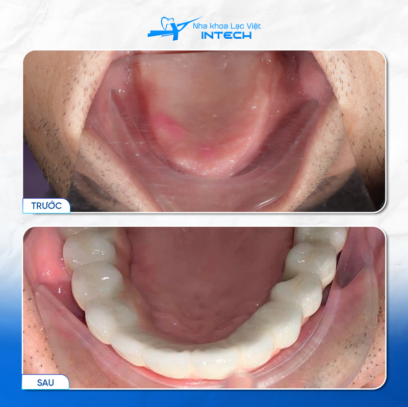 Chi phí trồng hàm giả tháo lắp trên Implant sẽ thay đổi theo vật liệu hàm, số lượng răng giả và số lượng trụ Implant