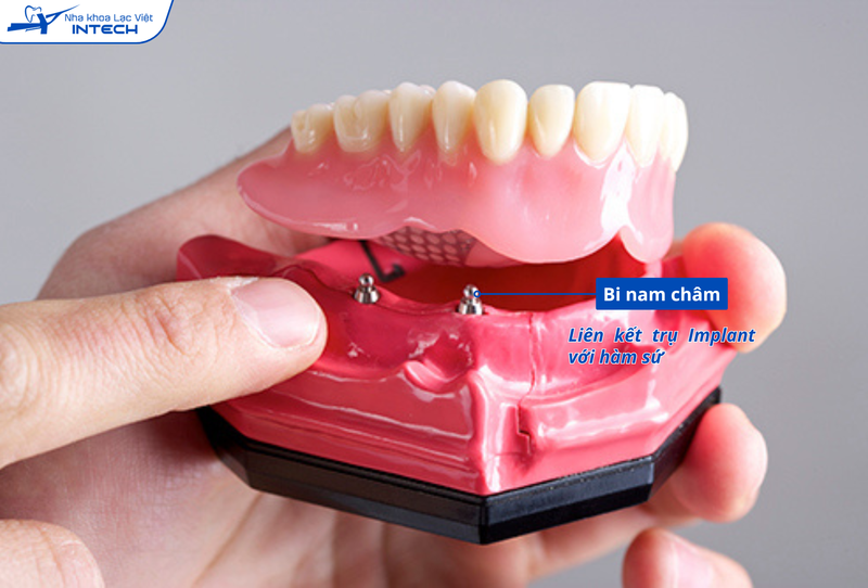 Do không liên kết cố định nên hàm tháo lắp trên Implant chịu lực nhai kém hơn hàm cố định