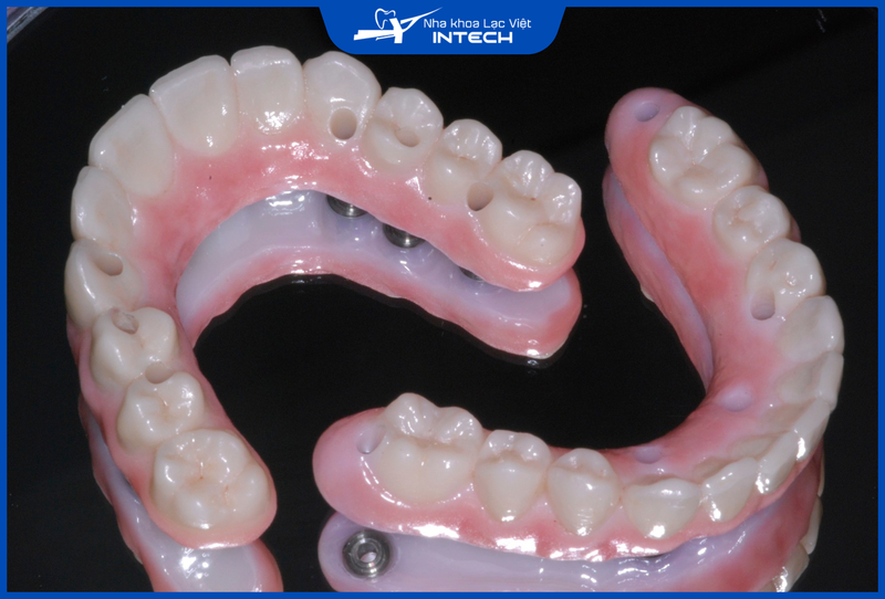 Hàm tháo lắp trên Implant cần được tháo ra và vệ sinh thường xuyên để tránh các tác nhân ăn mòn