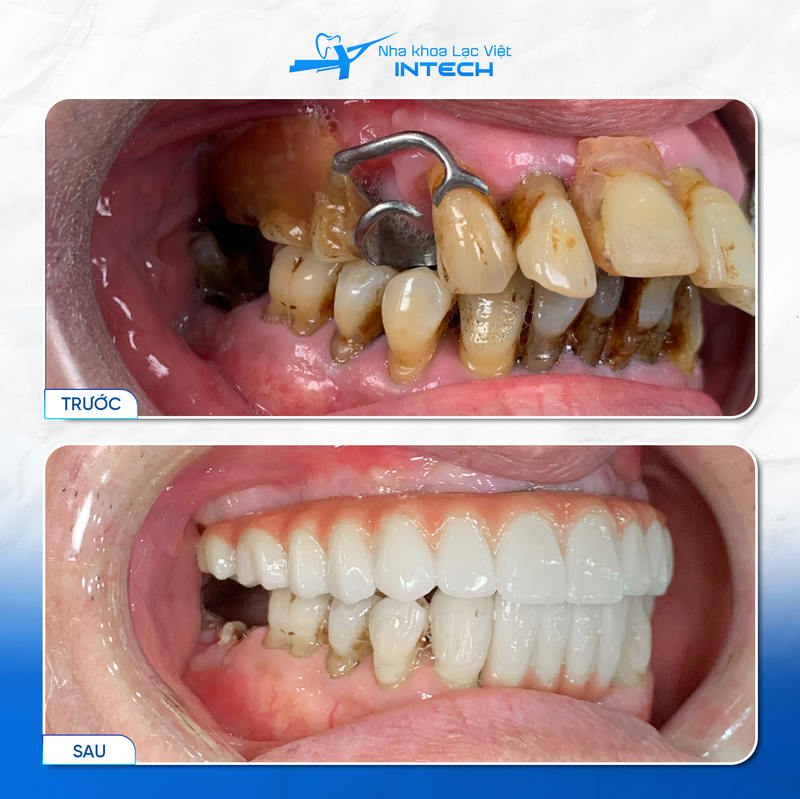 Hàm tháo lắp trên Implant không bị lộ móc kém thẩm mỹ