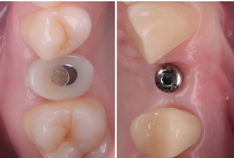 Trụ lành thương cá nhân hóa (bên trái) có khả năng tái lập hình thể giải phẫu lợi như răng thật