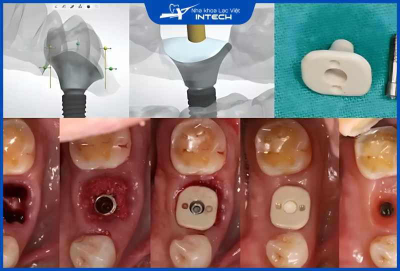 Trụ lành thương cá nhân hóa được chế tác bằng công nghệ CAD/CAM 5 trục, đảm bảo tính chính xác gần như tuyệt đối cho trụ lành thương