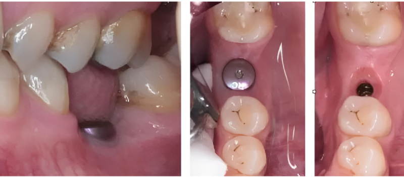 Trụ lành thương chế tác sẵn bằng Titanium không có khả năng tạo độ phồng cho lợi
