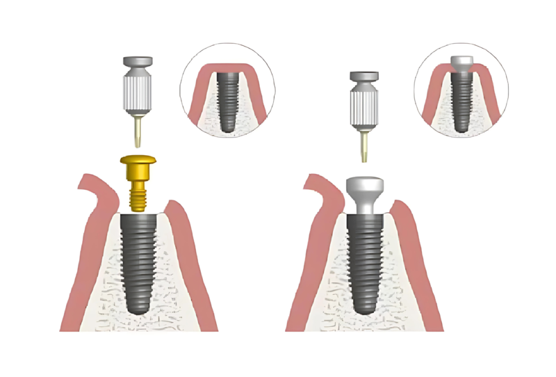 Trụ lành thương là bộ phận được đặt lên chân răng Implant sau quá trình đặt trụ Implant