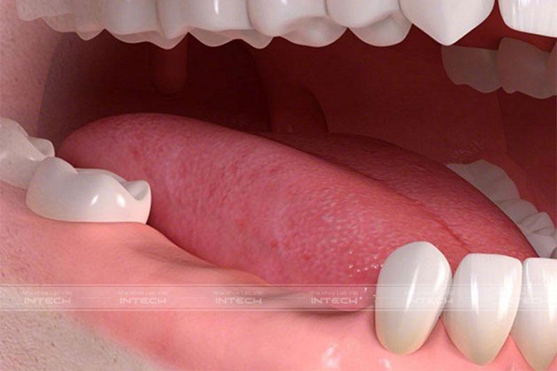 Tình trạng mất nhiều răng