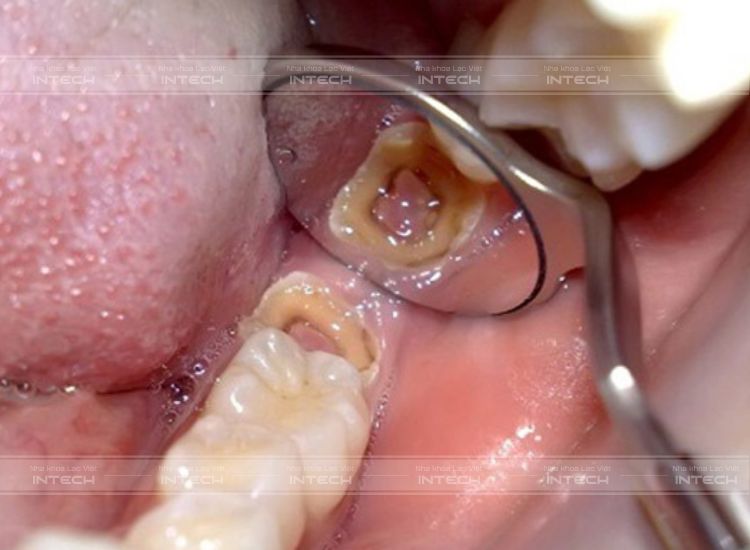 Hiện tượng sâu răng 8