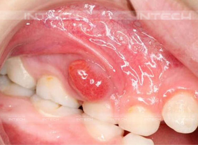 Hình thành các túi mủ
