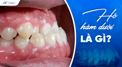 Hô hàm dưới là gì? Chỉnh răng hàm dưới nhô ra như thế nào?