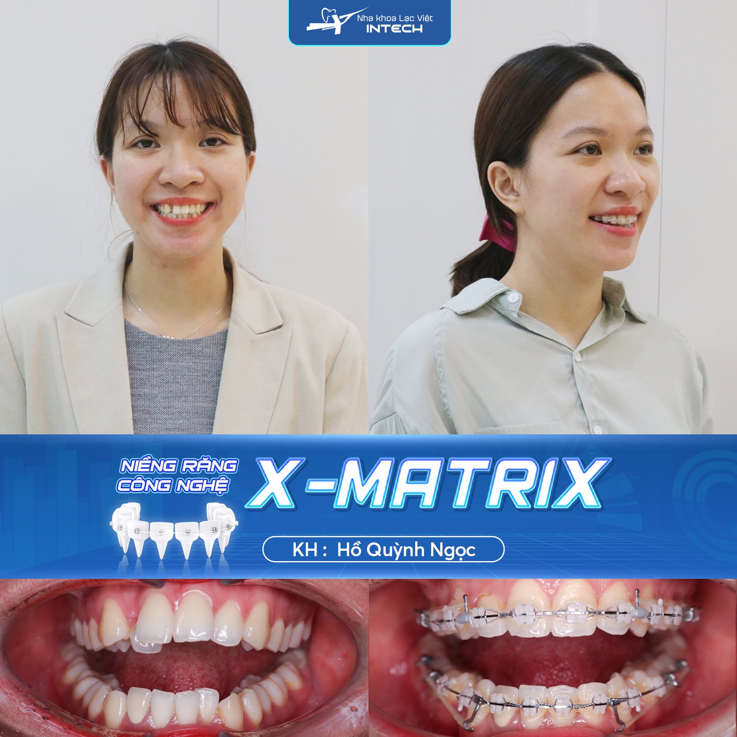 niềng răng hô hàm trên