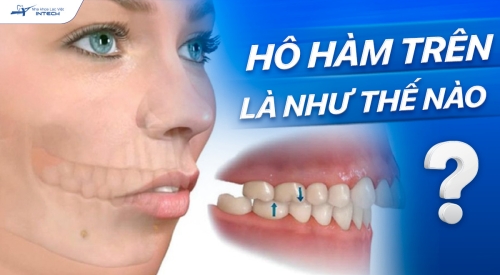 Hô hàm trên là như thế nào? Có niềng răng được không?