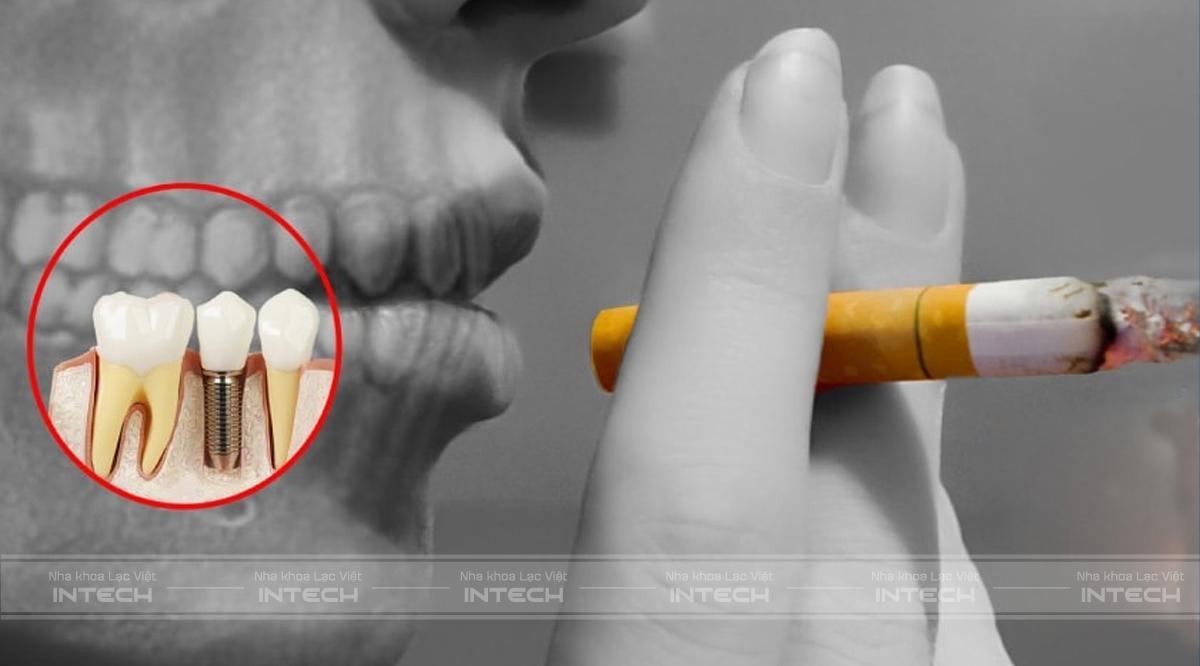 Nghiện hút thuốc lá không thể cấy ghép implant
