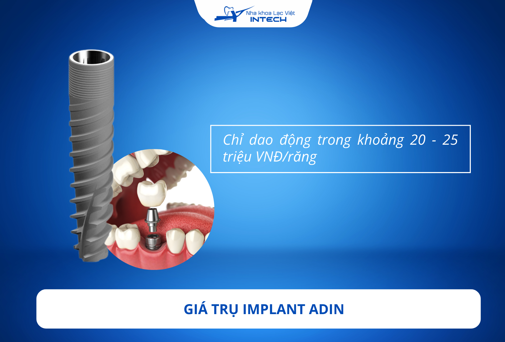 Trụ Implant Adin có chi phí tầm trung phù hợp với tài chính của cô chú/anh chị