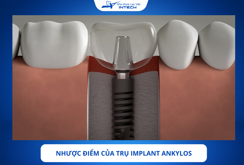 Một trong những nhược điểm lớn nhất của Implant Ankylos là chưa được sử dụng rộng rãi tại Việt Nam