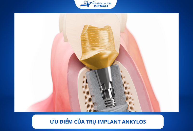 Implant Ankylos được đánh giá cao nhờ thiết kế tối ưu, giúp duy trì ổn định mô mềm và xương quanh trụ trong thời gian dài