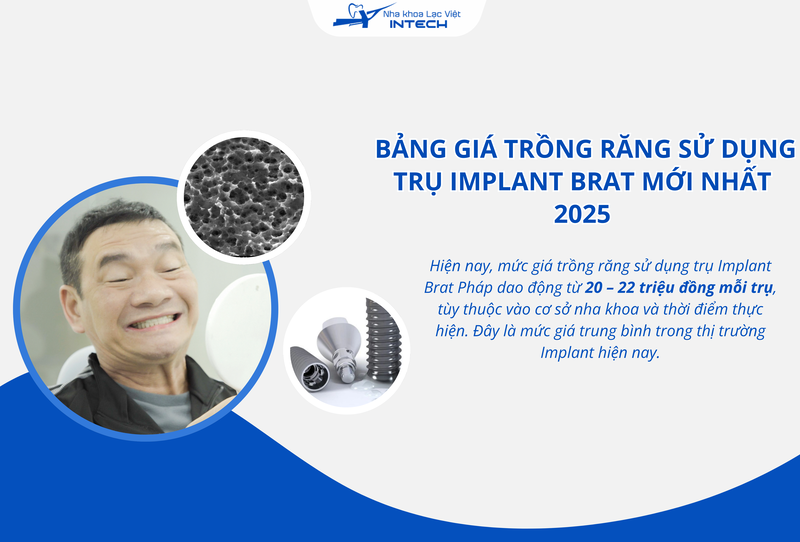 Giá trồng răng với trụ Implant Brat Pháp thay đổi theo địa chỉ nha khoa và thời điểm