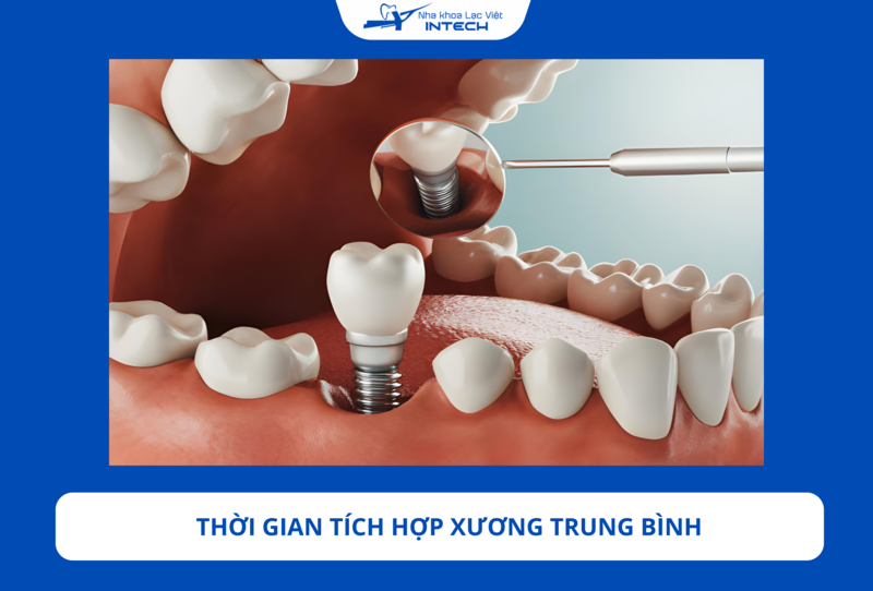 Trụ Brat Pháp cần thời gian tích hợp lâu hơn do đặc tính thiết kế và chất liệu