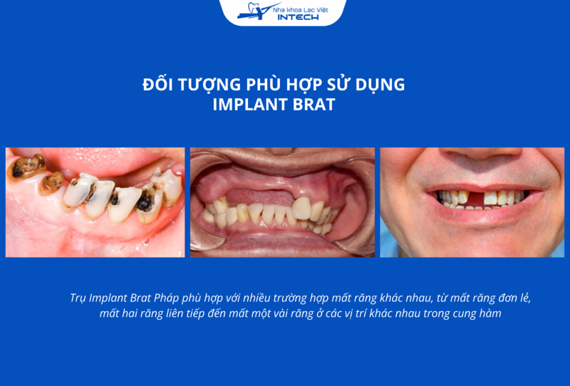 Trụ này có thể đảm bảo tính ổn định và hiệu quả khi cấy vào xương hàm ở những trường hợp mất răng ít