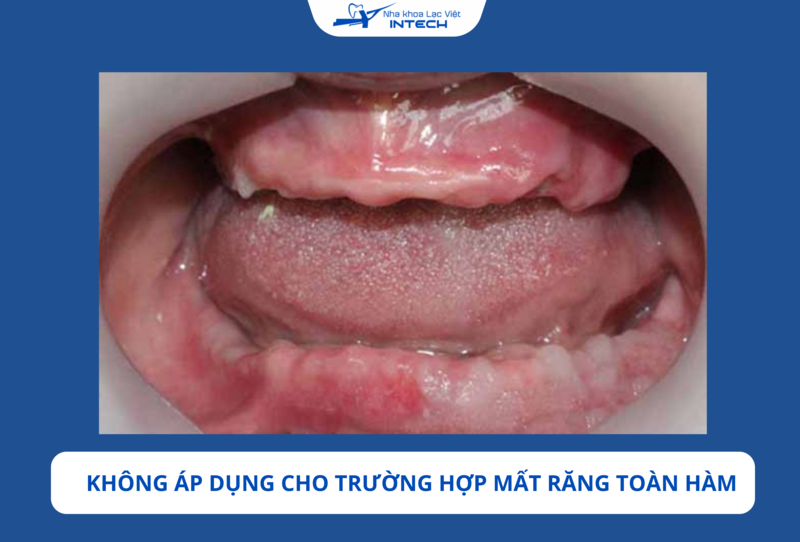Việc sử dụng trụ Brat Pháp trong trường hợp mất răng hoàn toàn có thể dẫn đến nguy cơ không đạt được sự ổn định cần thiết