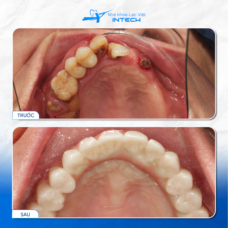 Trụ Implant Dentium có giá thành rẻ, chất lượng tốt, phù hợp cho những cô chú/anh chị cần phục hình nhiều răng với chi phí hợp lý