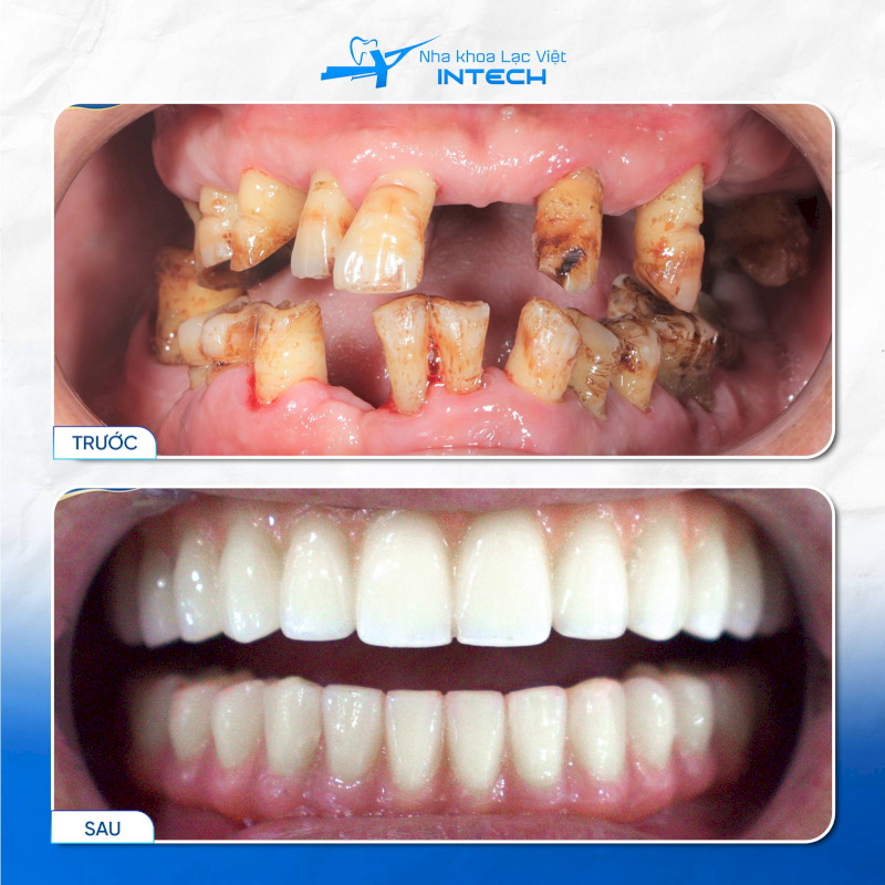 Trụ Implant Dentium Hàn Quốc phù hợp với nhiều tình trạng mất răng