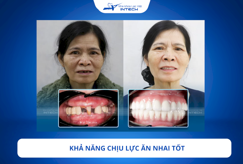 Trụ Implant Dentium Mỹ có khả năng chịu lực ăn nhai tốt, không thua kém gì răng thật, mang lại cảm giác thoải mái và tự nhiên khi ăn uống