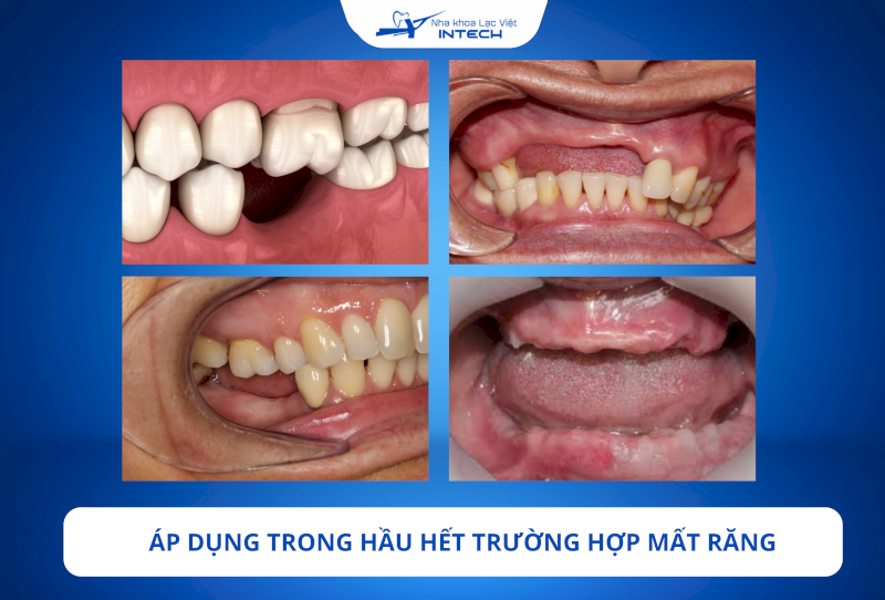 Trụ Implant Dentium Mỹ có thiết kế và kích thước đa dạng, phù hợp với mọi trường hợp mất răng