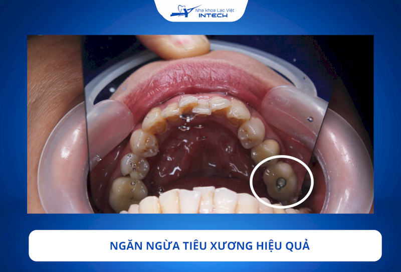 Trụ Implant Dentium Mỹ được cắm trực tiếp vào xương hàm giúp ngăn ngừa hiệu quả tình trạng tiêu xương