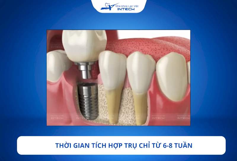 Trụ Implant Dentium Mỹ được xử lý bề mặt bằng công nghệ SLA tiên tiến, giúp tạo điều kiện thuận lợi để các tế bào xương bám vào và phát triển