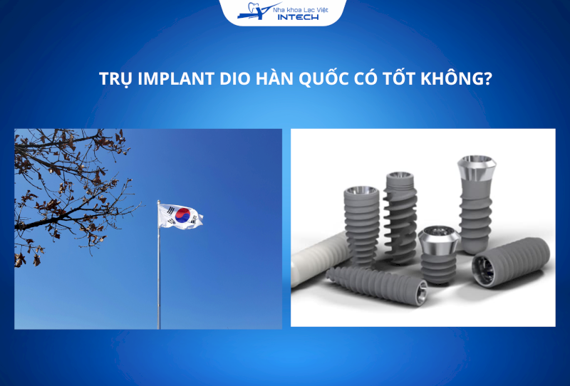 Trụ Implant Dio Hàn Quốc có tốt không? Chi phí thế nào?