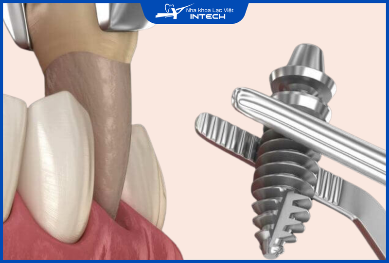 Trụ Implant ETK Active có thể ứng dụng trong cả trồng răng đơn lẻ, cầu răng Implant hoặc toàn hàm  