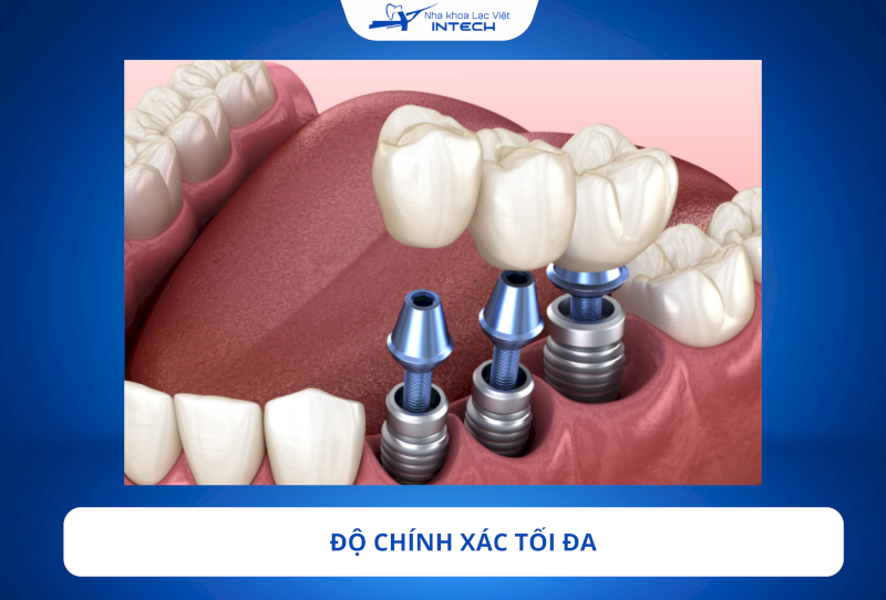 Trụ Implant MIS C1 được cung cấp kèm theo mũi khoan XD sử dụng một lần, đảm bảo tính vô trùng và độ chính xác cao