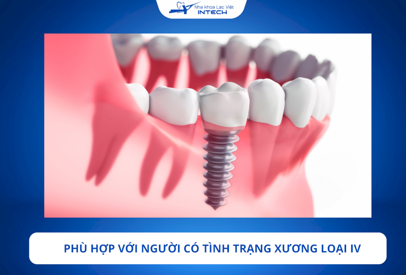 Trụ Implant MIS C1 phù hợp với những trường hợp xương hàm loại IV, giúp tăng tỷ lệ thành công khi cấy ghép