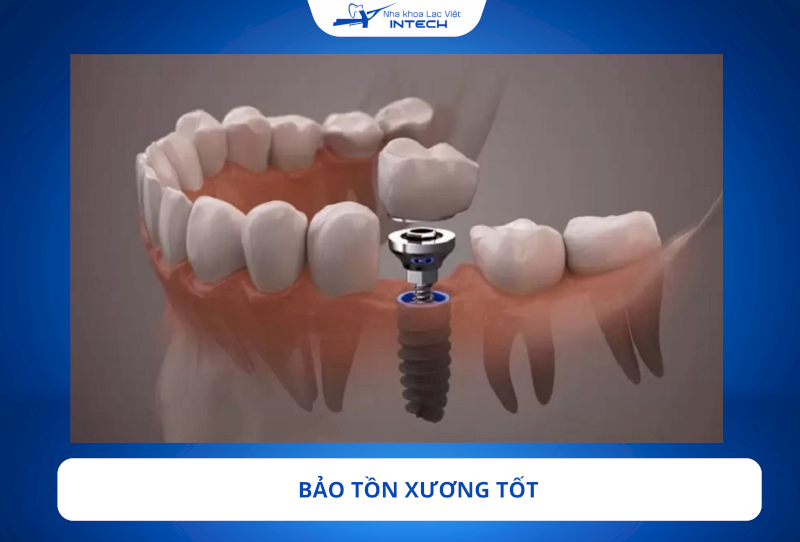 Trụ Implant MIS C1 sử dụng công nghệ thiết kế chuyển đổi nền tảng để tối ưu hóa việc bảo tồn xương hàm