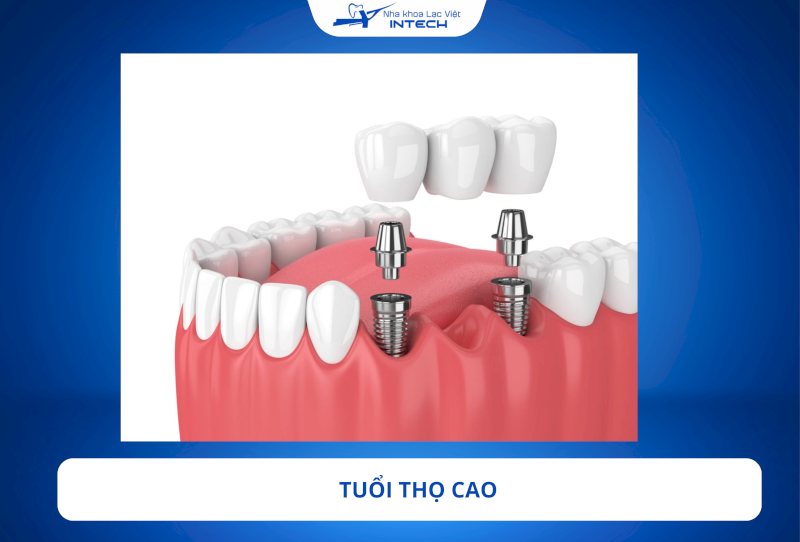 Trụ Implant NTA có thể đạt tuổi thọ trên 20–25 năm nếu được chăm sóc đúng cách