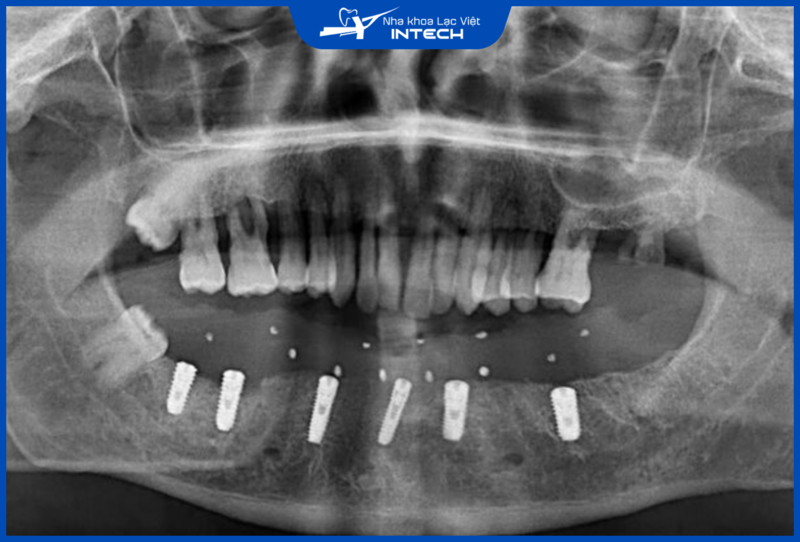 Osstem sản xuất đa dạng dòng trụ với thiết kế, kích thước và kiểu dáng khác nhau, đáp ứng cho mọi trường hợp phục hình