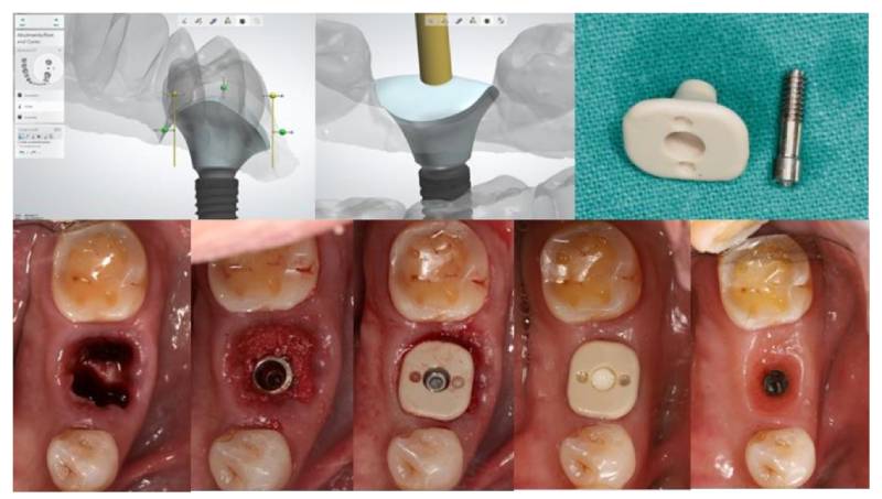 Giải pháp trồng răng Implant cá nhân hóa DCT khắc phục phần lớn nhược điểm của phương pháp trồng răng Implant truyền thống 