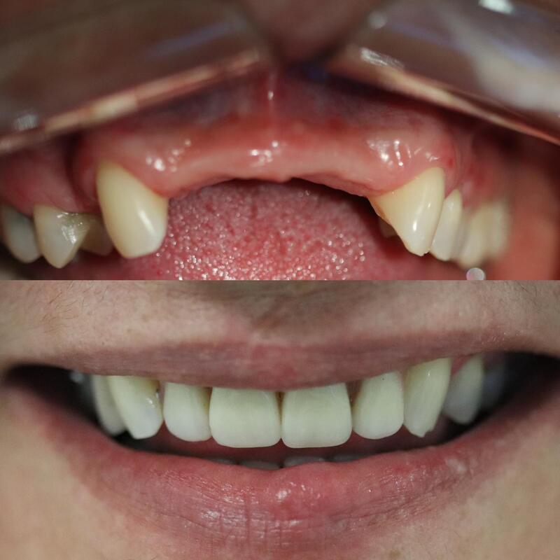 Quy trình cắm Implant răng cửa có thể thay đổi theo tình trạng cá nhân của cô chú/anh chị   