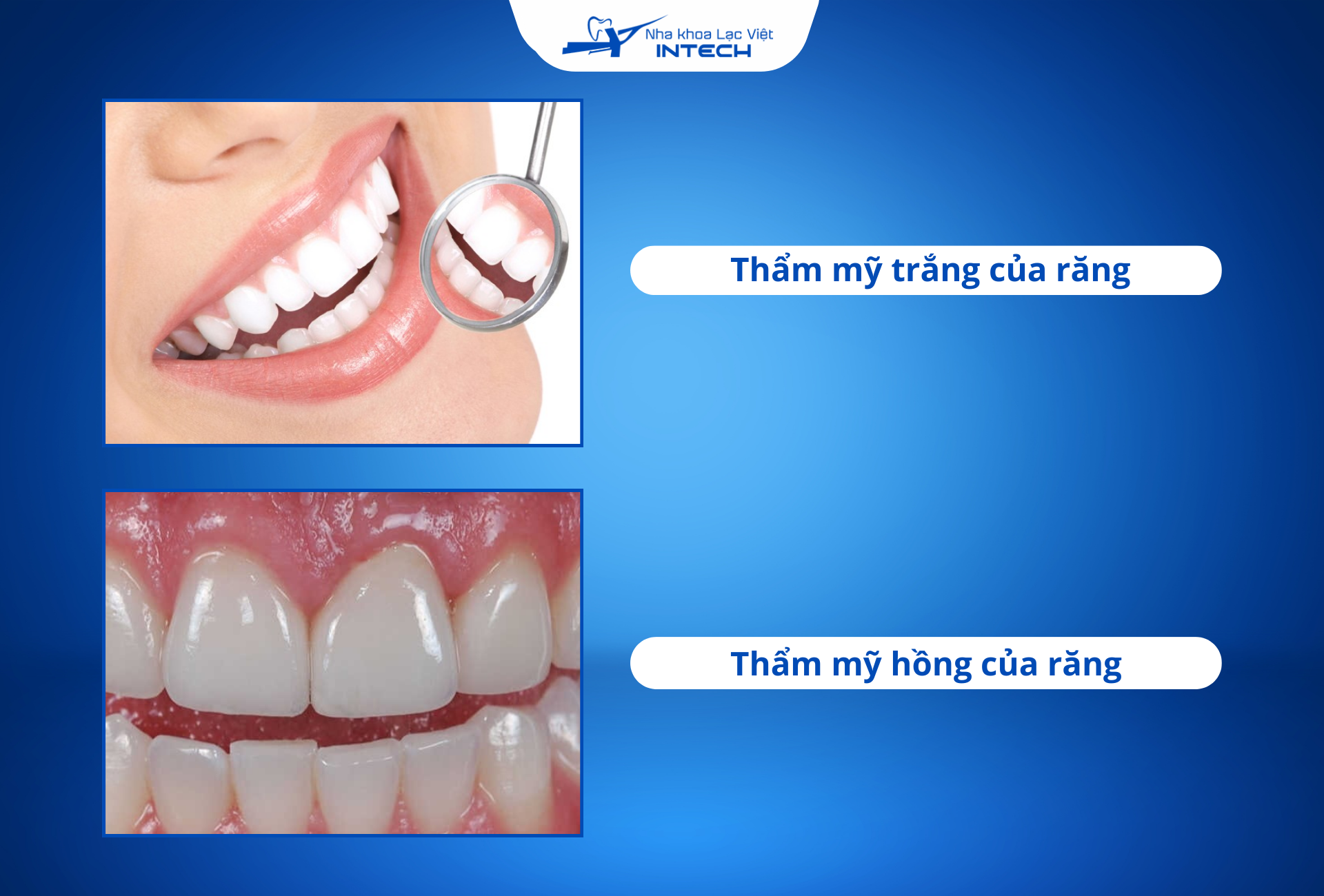 Một chiếc Implant răng cửa cần đáp ứng được chức năng thẩm mỹ trắng và thẩm mỹ hồng để mang lại cho hài sự hài hòa cho khuôn mặt  