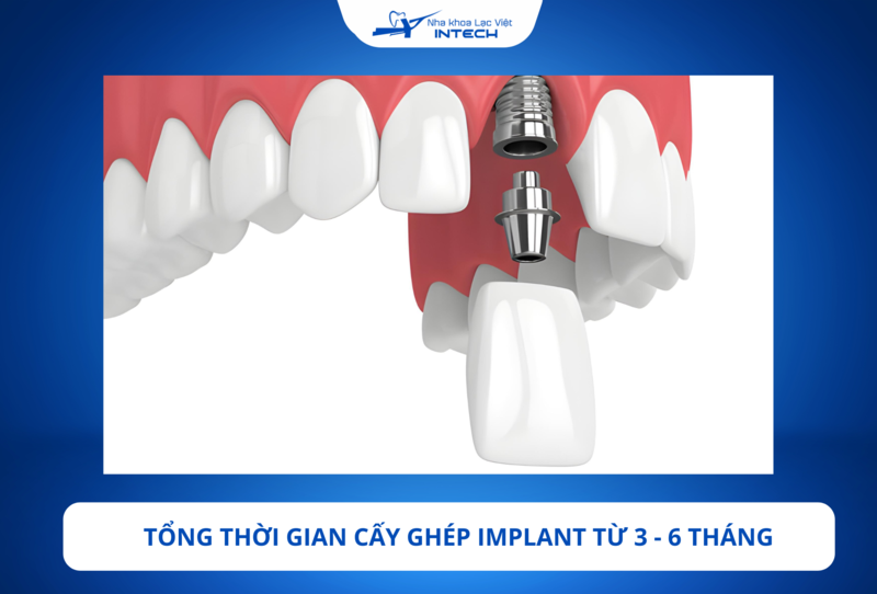 Lấy lại nụ cười tự tin với phương pháp trồng Implant răng cửa