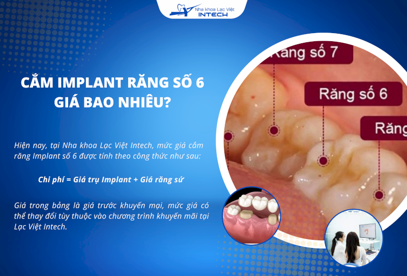 Bảng giá trồng răng Implant có thể thay đổi tùy thuộc vào chương trình khuyến mãi