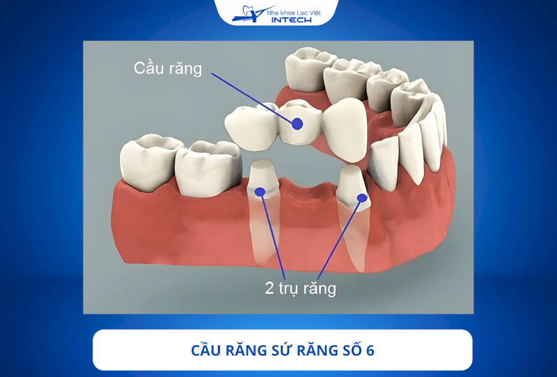 Cầu răng sứ có thiết kế tinh xảo, mô phỏng màu sắc và hình dáng giống răng thật