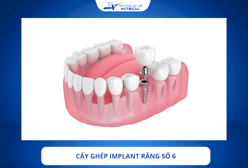Cấy ghép Implant răng số 6 là giải pháp phục hình hiện đại, giúp tái tạo khả năng ăn nhai và đảm bảo tính thẩm mỹ tối đa.