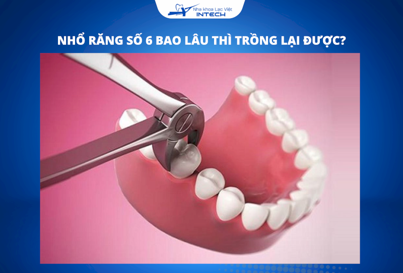 Cô chú/anh chị cần chờ khoảng 3-6 tháng sau khi nhổ răng số 6 để vết thương ổn định