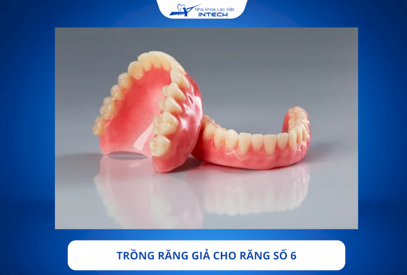 Trồng răng giả là phương pháp phục hình răng số 6 đã mất thuận tiện cho việc vệ sinh