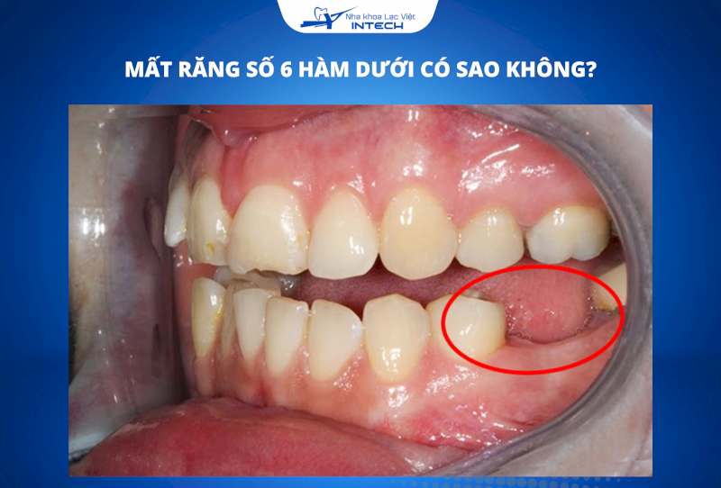 Việc mất răng số 6 không chỉ làm suy giảm chức năng ăn nhai